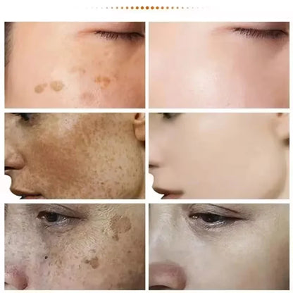 Powerful Spot-removing Whiten Cream Brighten Skin Fast Eliminates Melanin Pigmentation Melasma Dark Spots Korean Skin Care 2024