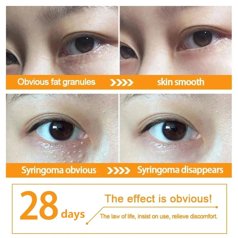 Fat Granules Remover Eye Cream Anti-Puffiness Anti Inflammatory Reduce Dark Circles Eyebags  Fade Lines Moisturizing Eye Care